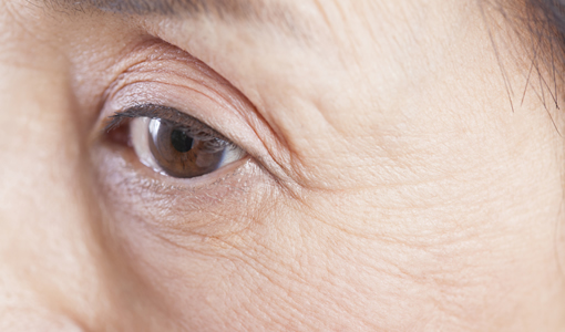 眼瞼下垂・<br>上まぶたのたるみ